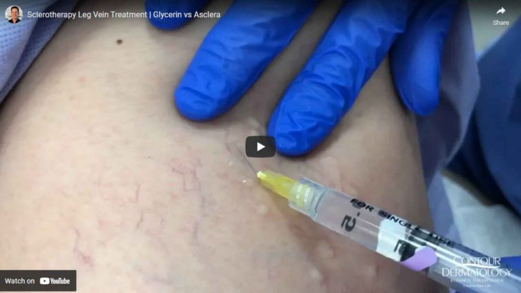 Sclerotherapy for Spider Veins on Legs