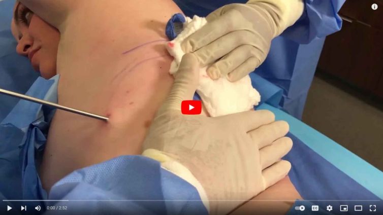 Tumescent Liposuction for the Back – Fat Transfer for Butt Dimples