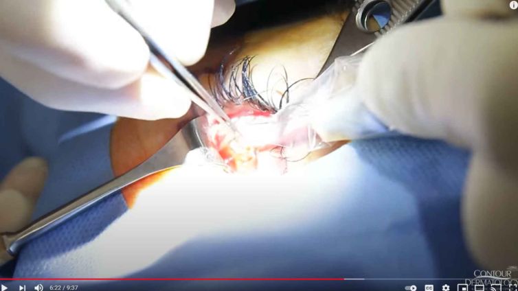 Lower Eyelid Surgery (Lower Blepharoplasty)