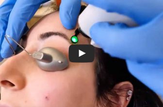 Vbeam Perfecta for Red Spots