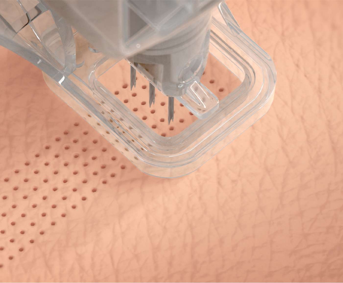 Ellacor is unique and different from other skin revitalization devices because it removes micro-portions of excess skin to improve the appearance of wrinkles.