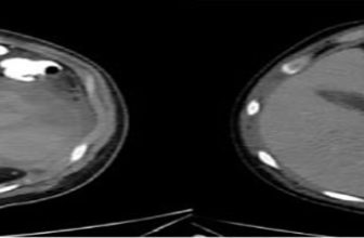 Management of Hemorrhagic Walled-Off Necrosis Using the Multiple Transluminal Gateway Technique