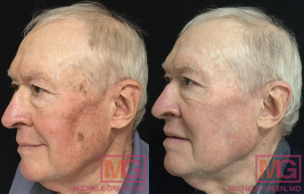 RL 74yo male before and after ED AlexTrivantage and Fraxel LEFT MGWatermark