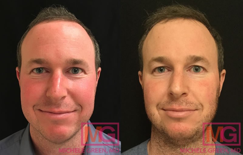 28 male vbeam before after FRONT MGwatermark 1