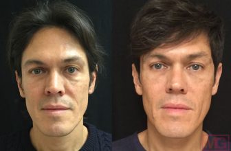 What Are The Best Non-Invasive Wrinkle Treatments