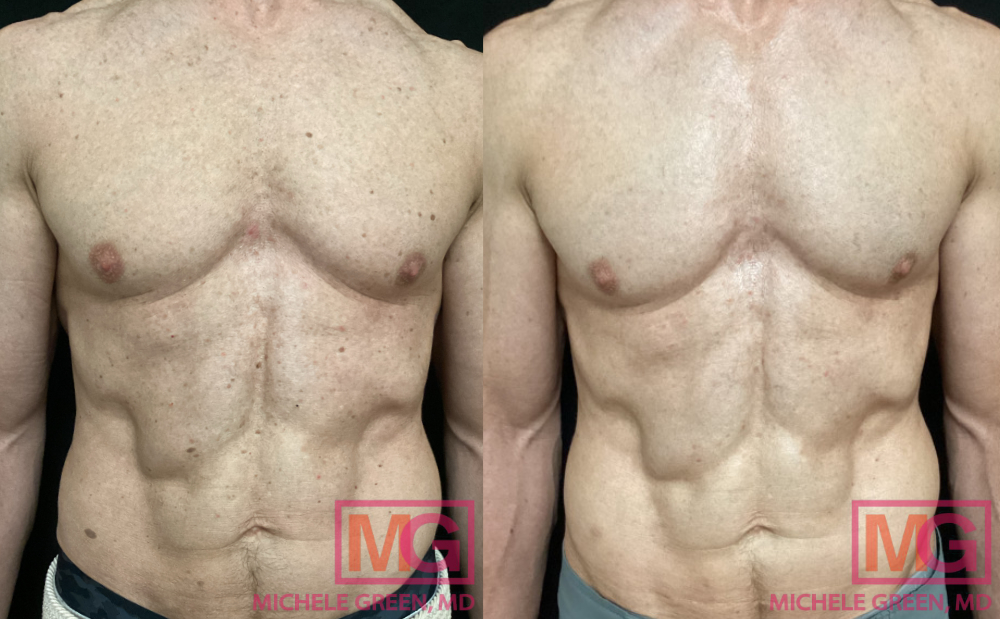 JB 61 yr old male before and after Fraxel and Alex trivantage laser treatment of sun spots and seborrheic keratosis MGWatermark
