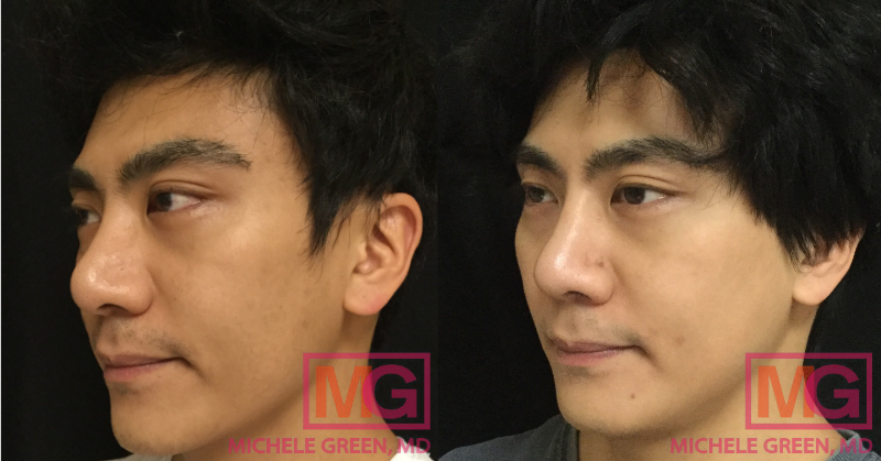 MH 34 Before and After Chemical Peel 4 sessions 6 months LEFT MGWatermark