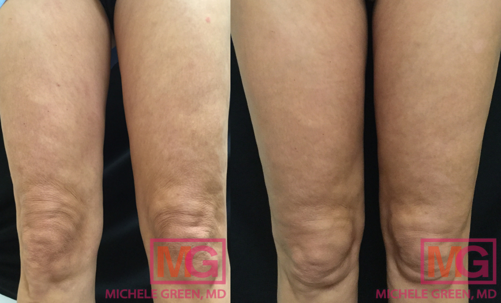 NB Before and After Thermage Lower thighs and knees MGWatermark