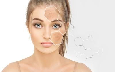 Woman with facial hyperpigmentation spots