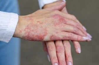 Triggers, Symptoms, and Treatment Options