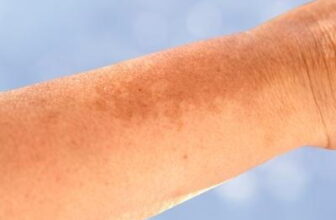 What to Know About Hyperpigmentation and Uneven Skin Tone