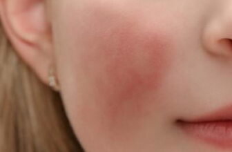 Identifying Triggers and Building an Effective Skin Care Rout