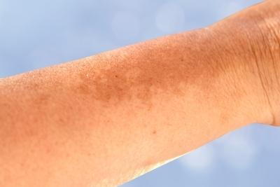 Close-up of arm showing dark spots and uneven skin pigmentation