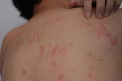 Close-up of back showing raised red patches from hives reaction