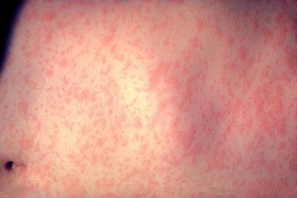 Measles rash on the stomach, showing red maculopapular spots characteristic of viral rashes caused by measles
