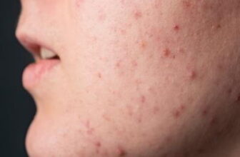 What to Know About Acne Treatment Options