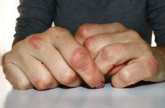 How to Prevent and Manage Eczema Flare-Ups