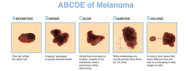 ABCDE warning signs of melanoma skin cancer