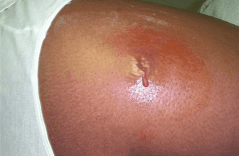 Abscess