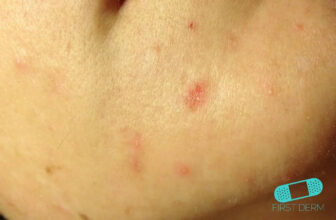 Acne Scars