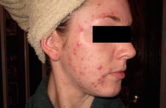 Acne Nodulocystica (Nodular acne)