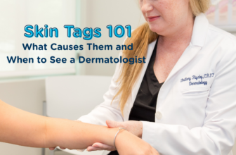 Skin Tags 101: What Causes Them and When to See a Dermatologist