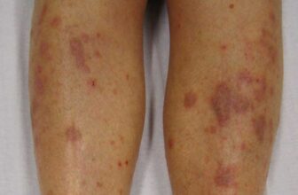 Lichen Planus – Online Dermatology