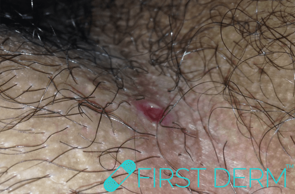 small, round, reddish sore (chancre) in the groin area, characteristic of primary syphilis caused by Treponema pallidum. The sore is slightly raised with a smooth surface, surrounded by hair and slightly inflamed skin ICD 10 A51.0