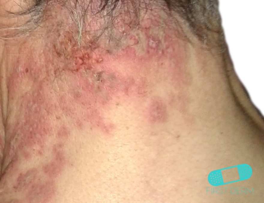 Shingles rash on the neck with visible dark patches and open blisters indicative of herpes zoster progression. ICD-10-B02