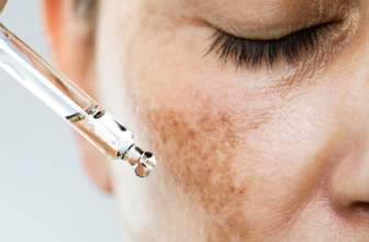 Treating Hyperpigmentation | Pure Dermatology