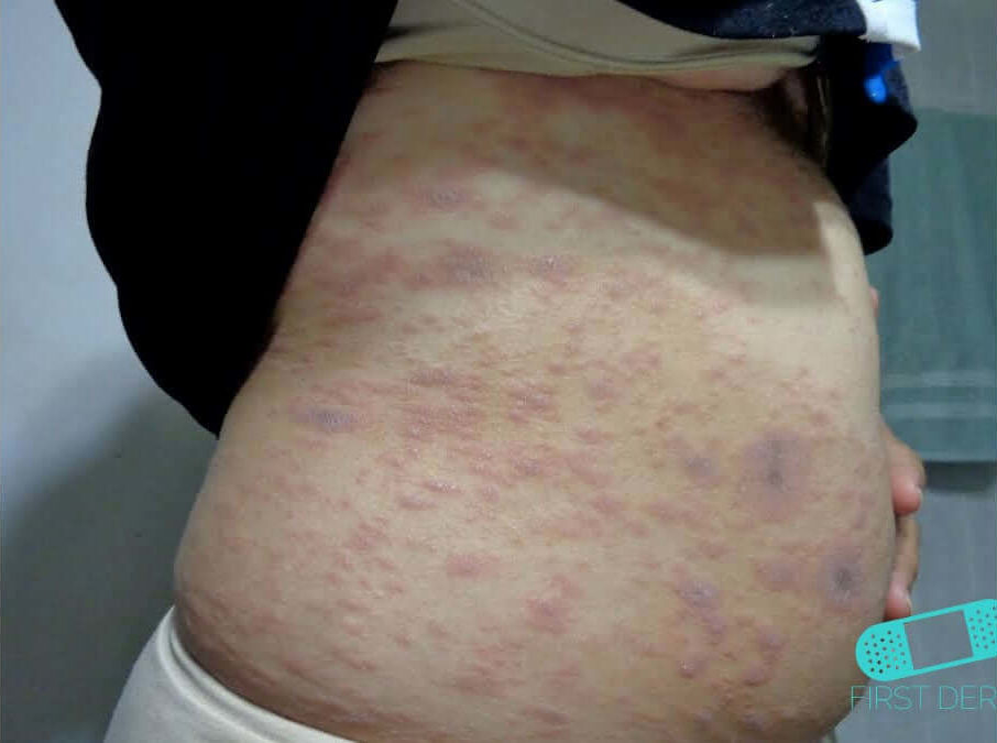 Lichen planus on the abdomen showing multiple reddish-purple, itchy bumps that merge into larger plaques