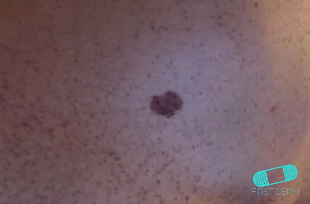 Malignant Melanoma torso [ICD-10 C43.9] on the torso showing a distinct, darkly colored lesion indicative of potential skin cancer 