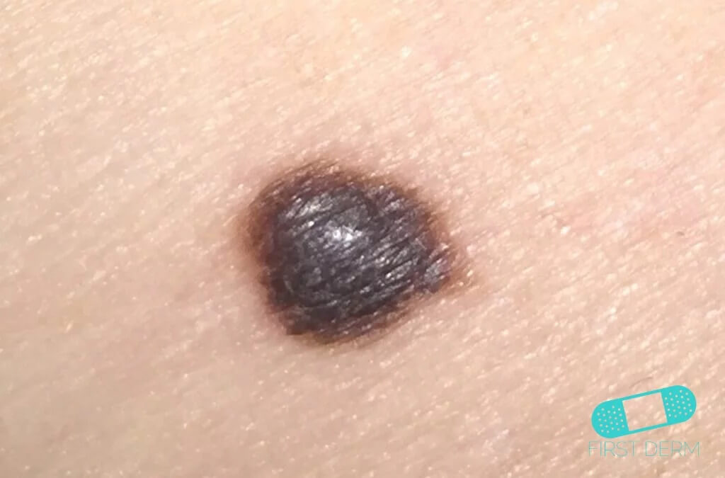 Malignant Melanoma (25) face [ICD-10 C43.9] showing an irregularly shaped, dark brown to black lesion