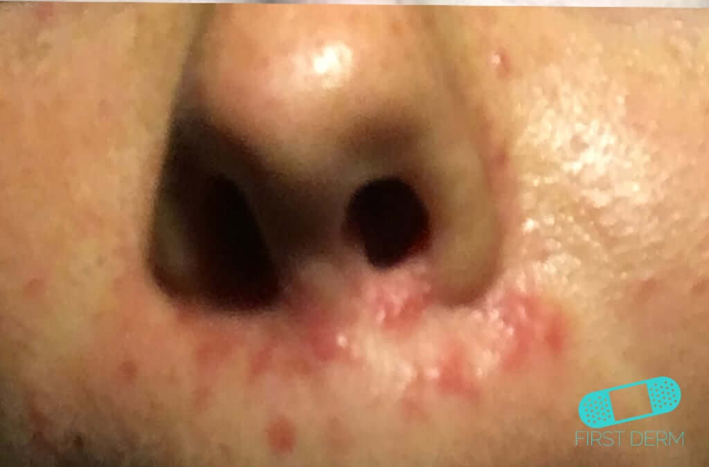 Perioral Dermatitis (07) nose [ICD-10 L71.0] Close-up of the lower face, emphasizing small red bumps and rash concentrated under the nose and above the upper lip, characteristic of Perioral Dermatitis. These symptoms specifically highlight the inflammation and irritation around the mouth and nasal openings