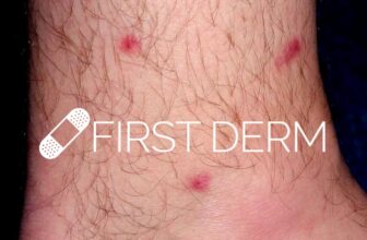 Itchy Red Bumps on Skin – Potential Causes and Treatment