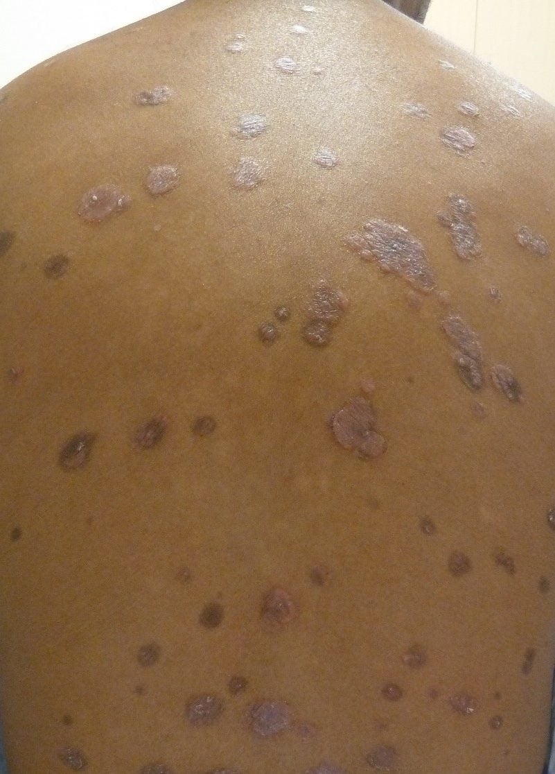 Syphilis, secondary stage, raised, red, scaly plaques: View of an individual's back showing numerous raised, red, scaly plaques characteristic of secondary syphilis. The plaques vary in size and are spread across the upper and lower back, with a rough texture and inflamed skin