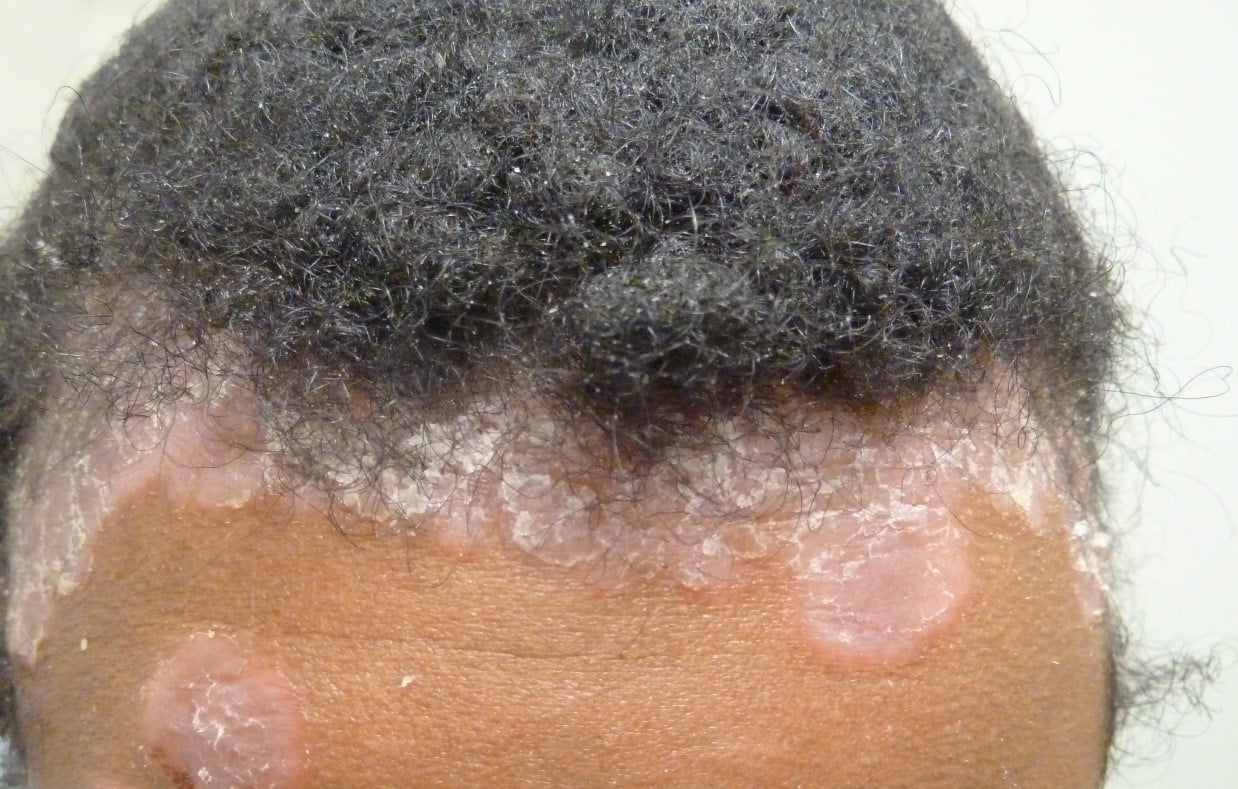 Syphilis, secondary stage, raised, red, scaly plaques: View of the scalp and forehead showing multiple circular, raised, red, scaly plaques indicative of secondary syphilis. The plaques have a well-defined border and are surrounded by inflamed skin with signs of peeling and flaking