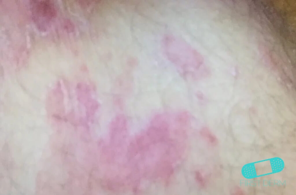 Reddish ring shaped raised spots due to Tinea infection