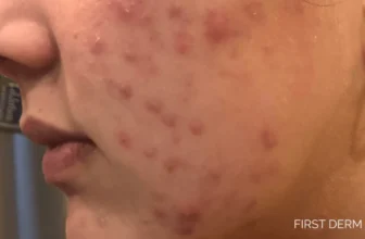 Acne Vulgaris (Zits) –