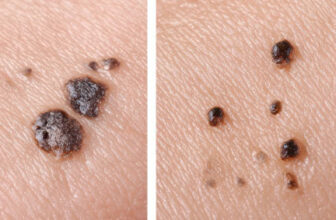 Stage 4 Melanoma: Understanding the Diagnosis