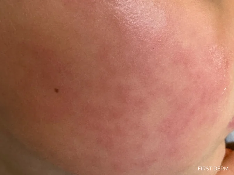 Child with fifth disease, also known as erythema infectiosum or slapped cheek disease, showing a bright red rash caused by human parvovirus B19