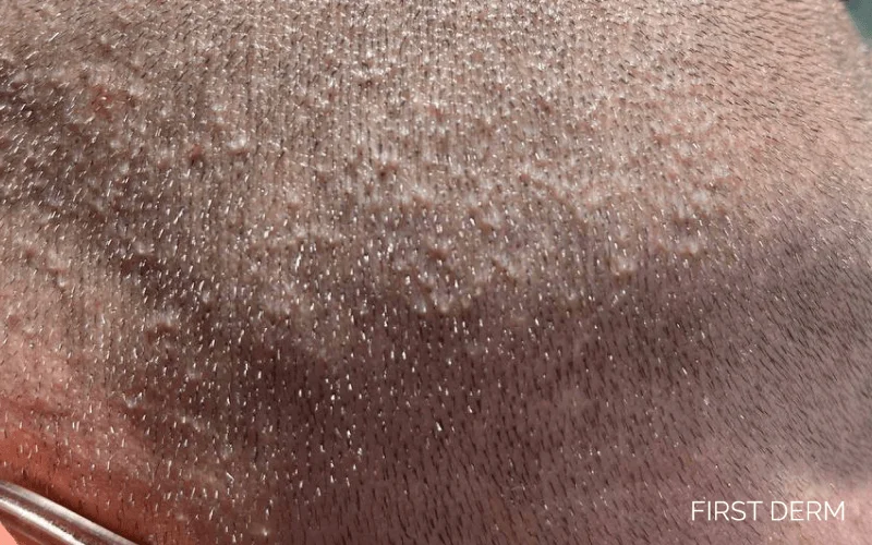 Heat rash (Miliaria) on the scalp, showing small, raised bumps due to blocked sweat ducts. The skin condition is commonly caused by heat and excessive sweating