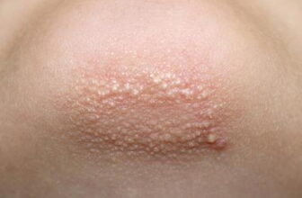 What Causes Those Bumpy Patches