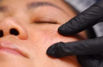What Causes Melasma and How It’s Treated