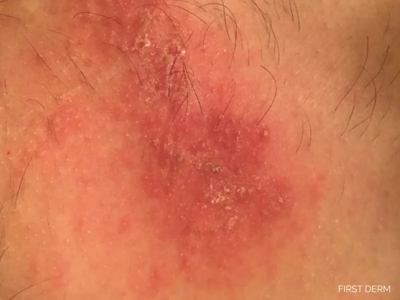 Shingles rash caused by a virus, showing red, inflamed skin and crusting, resulting from the reactivation of the varicella-zoster virus