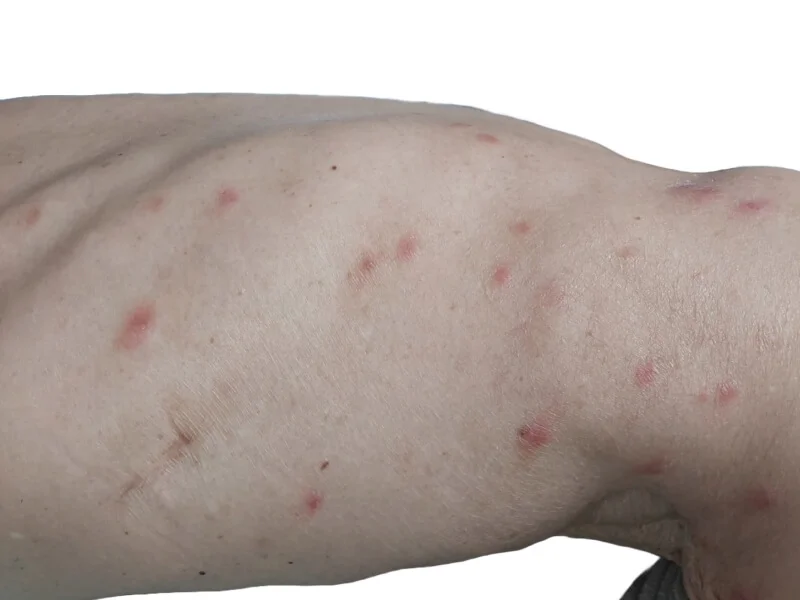 Red, itchy rash on the right side of the body and axilla caused by insect bites