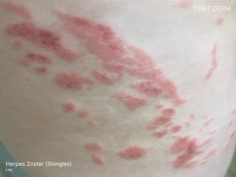 Shingles rash on right leg showing red, painful, inflamed patches of skin caused by herpes zoster