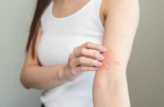How Diet, Stress, and Allergies Trigger Eczema