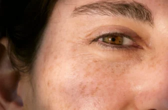 Skin Cancer Facts You Need to Know