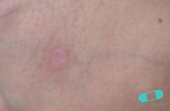 Syphilis – Online Dermatology